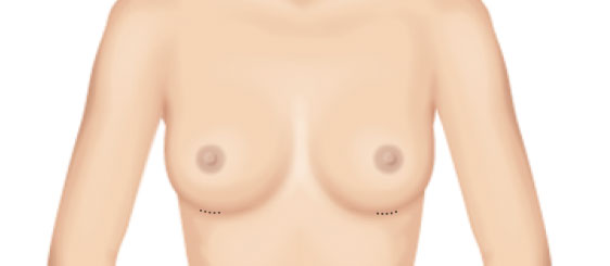 2公分隆乳的乳房假體植入位置